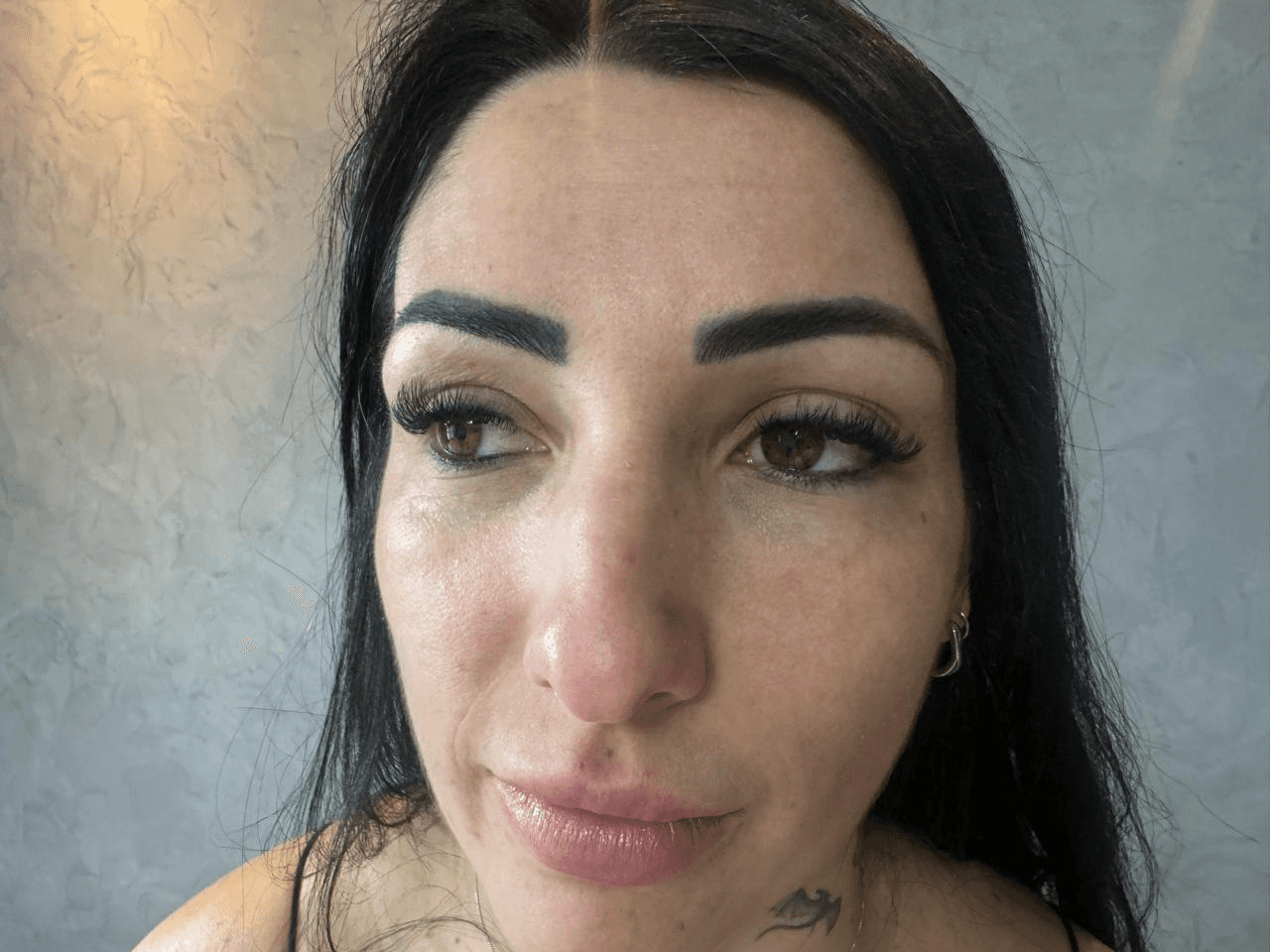 Depois — Preenchimento de olheiras